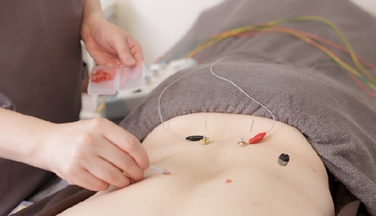 背中への鍼灸施術（電針と灸）の様子。