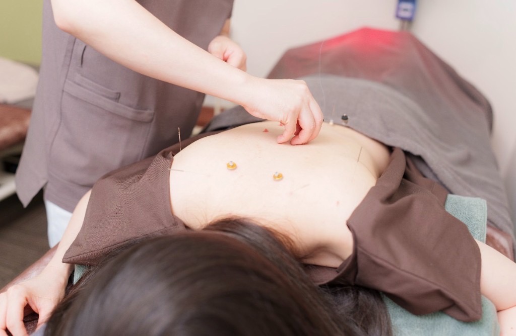 マタニティ鍼灸の施術イメージ。背中への鍼灸とお灸。