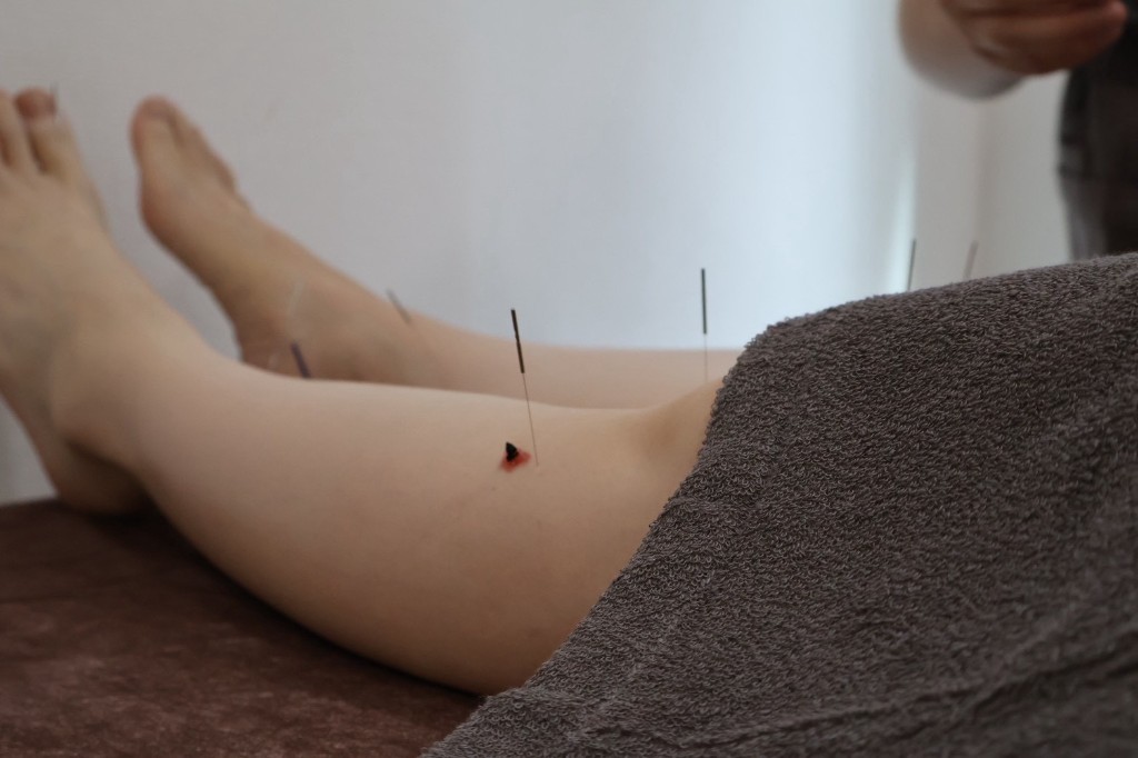 下肢への鍼灸治療の様子。お灸の煙が立ち上がっている。